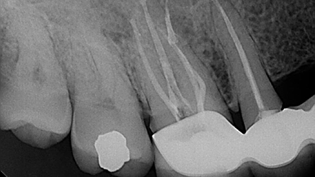 Precision Endodontics P.C. | 3615 Seneca St, Buffalo, NY 14224, USA | Phone: (716) 671-3009