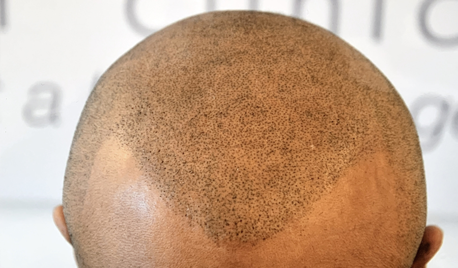 TRICHOLOGY CENTRE | Hair Loss and SMP Scalp Micropigmentation Ri | 9140 Leslie St Unit 301, Richmond Hill, ON L4B 3L6, Canada | Phone: (647) 492-9093