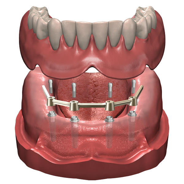 Clinique De Denturologie drummond | 458 Rue Lindsay, Drummondville, QC J2B 5L5, Canada | Phone: (819) 477-2447