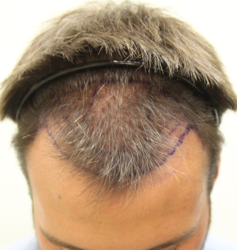 Rahal Hair Transplant Toronto | 1131 Leslie St #300, North York, ON M3C 3L8, Canada | Phone: (647) 559-2811