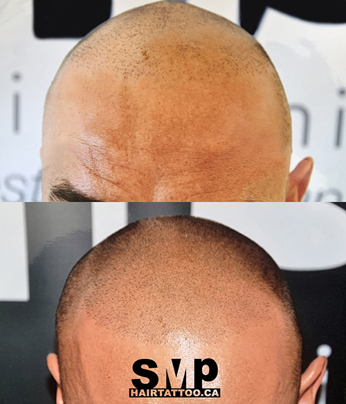 SMP® Scalp Micropigmentation Richmond Hill | HAIRTATTOO.CA | 9140 Leslie St #301, Richmond Hill, ON L4B 3L6, Canada | Phone: (647) 492-9093