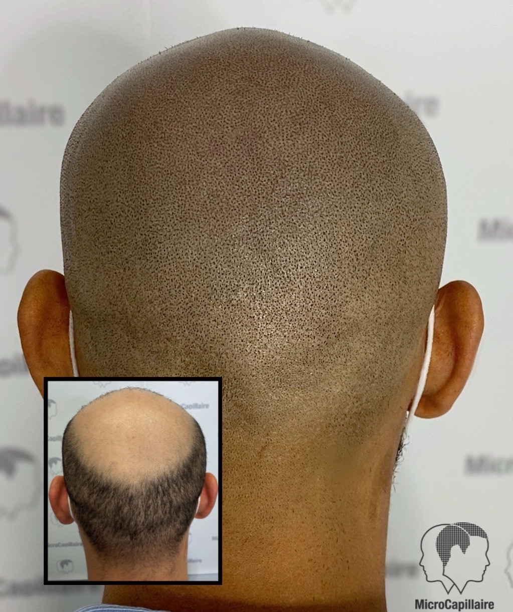 Clinique MicroCapillaire - Scalp Micropigmentation Capillaire | 2884 Chemin de Chambly, Longueuil, QC J4L 1G7, Canada | Phone: (450) 679-1888