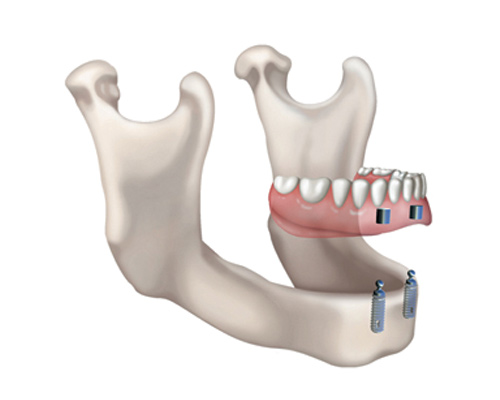 Denturologistes Cartierville | 5995 Boul Gouin O Suite 202, Montréal, QC H4J 2P8, Canada | Phone: (514) 336-8486