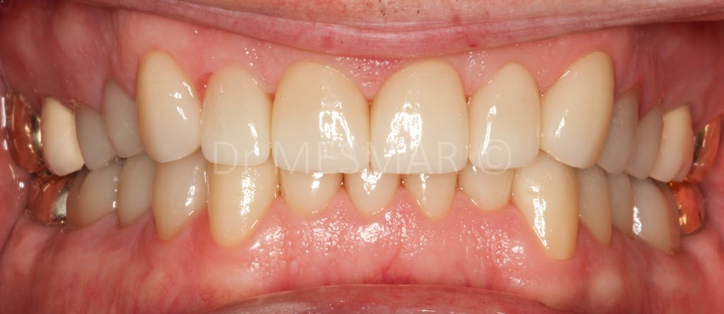 Le Prosthodontiste - Dr Samer Mesmar | 5255 Boul Henri-Bourassa O #402, Saint-Laurent, QC H4R 2M6, Canada | Phone: (514) 587-6696