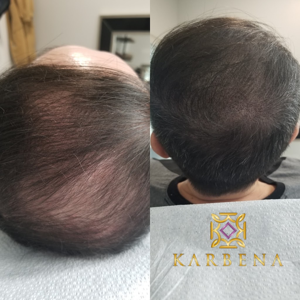 Karbena Scalp Micropigmentation | 22714 Dewdney Trunk Rd Suite 102, Maple Ridge, BC V2X 3K2, Canada | Phone: (778) 241-2433