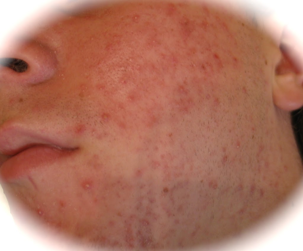 Acne Clinic " Miraculum" | 12761 16 Ave #108, Surrey, BC V4A 1N2, Canada | Phone: (604) 542-4221