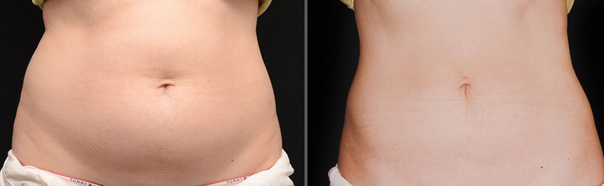 Coolsculpting Toronto Clinic | 249 Queens Quay W Unit #112A, Toronto, ON M5J 2N5, Canada | Phone: (855) 653-3131