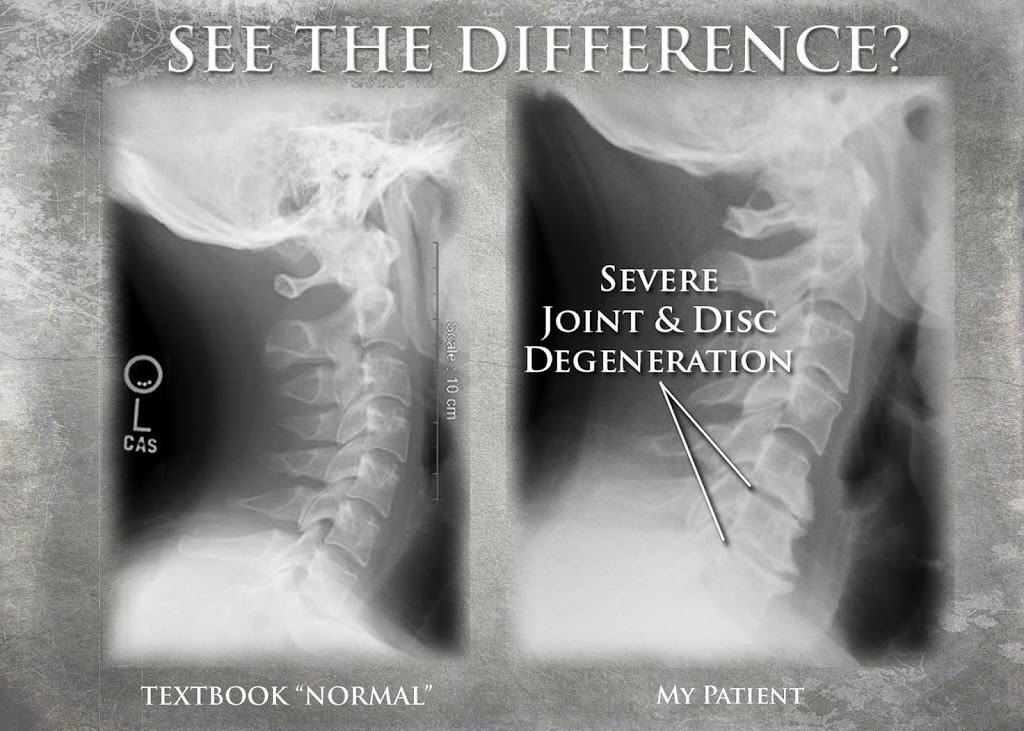 Ottawa Spinal Decompression Center | 2057 Meadowbrook Rd, Gloucester, ON K1B 4W7, Canada | Phone: (888) 456-0454