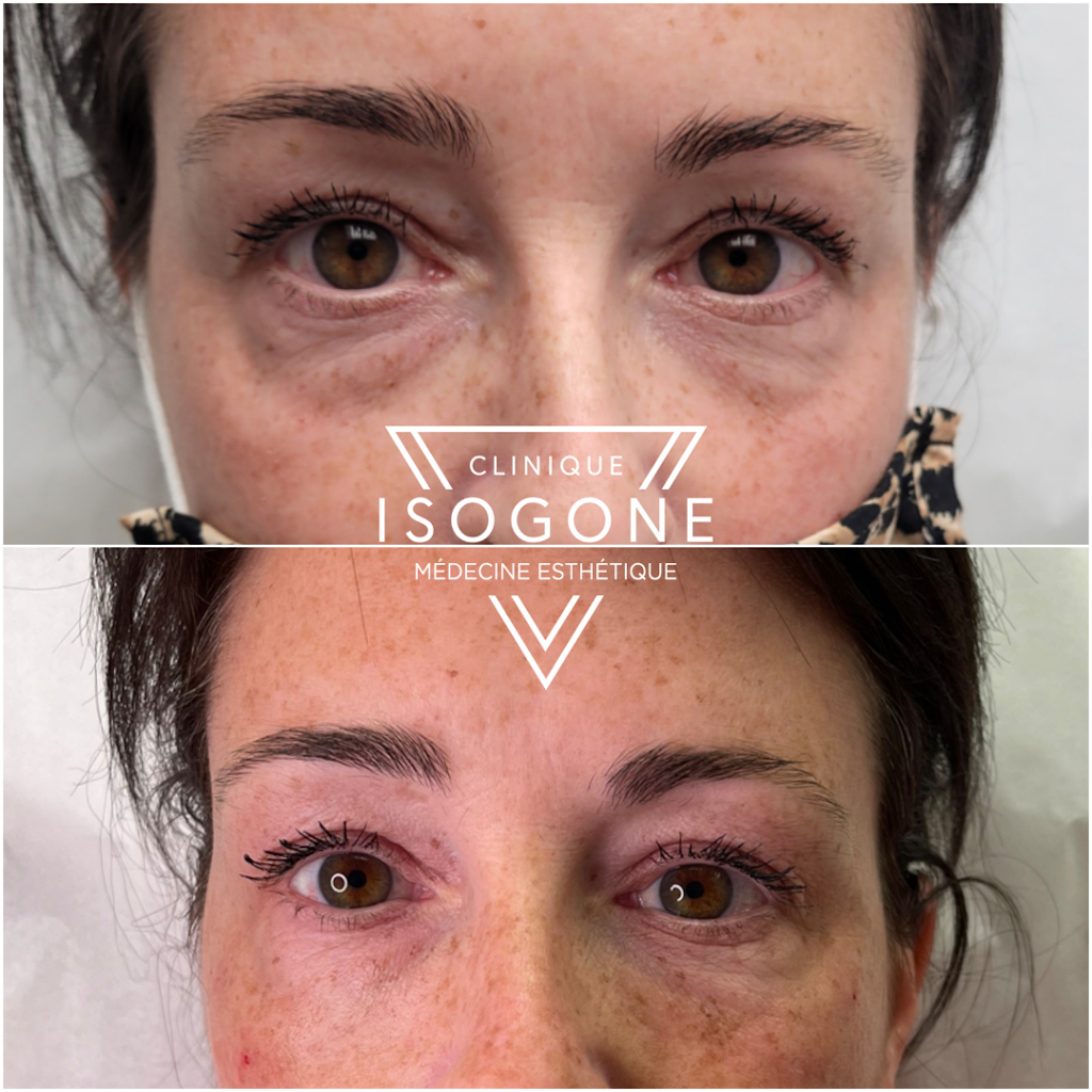 Clinique Isogone Médico-Esthétique | 1435 Boulevard Saint-Martin O Suite 502, Laval, QC H7S 2C6, Canada | Phone: (450) 667-6676