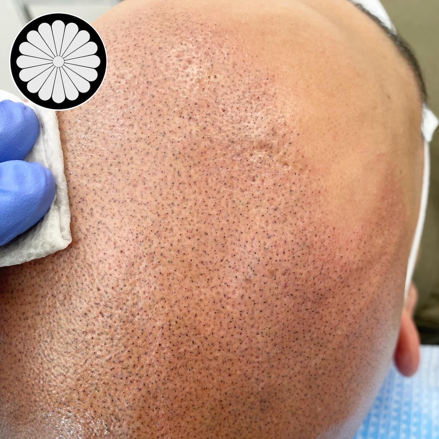 Vancouver Scalp Micropigmentation | 3787 Canada Way #218, Burnaby, BC V5G 1G5 | Phone: (604) 430-4990