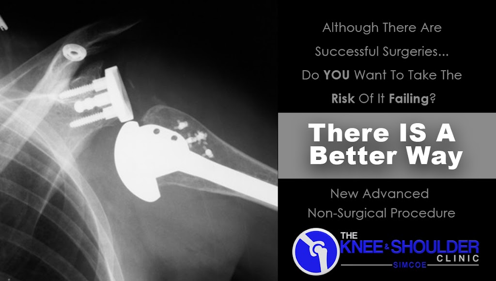 Simcoe Knee And Shoulder Clinic | 169 Dufferin St S Unit 5, Alliston, ON L9R 1E6, Canada | Phone: (705) 440-7333