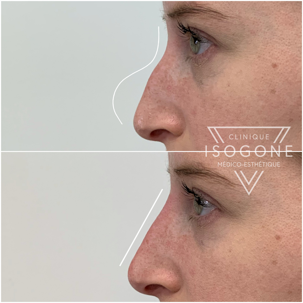 Clinique Isogone Médico-Esthétique | 1435 Boulevard Saint-Martin O Suite 502, Laval, QC H7S 2C6, Canada | Phone: (450) 667-6676