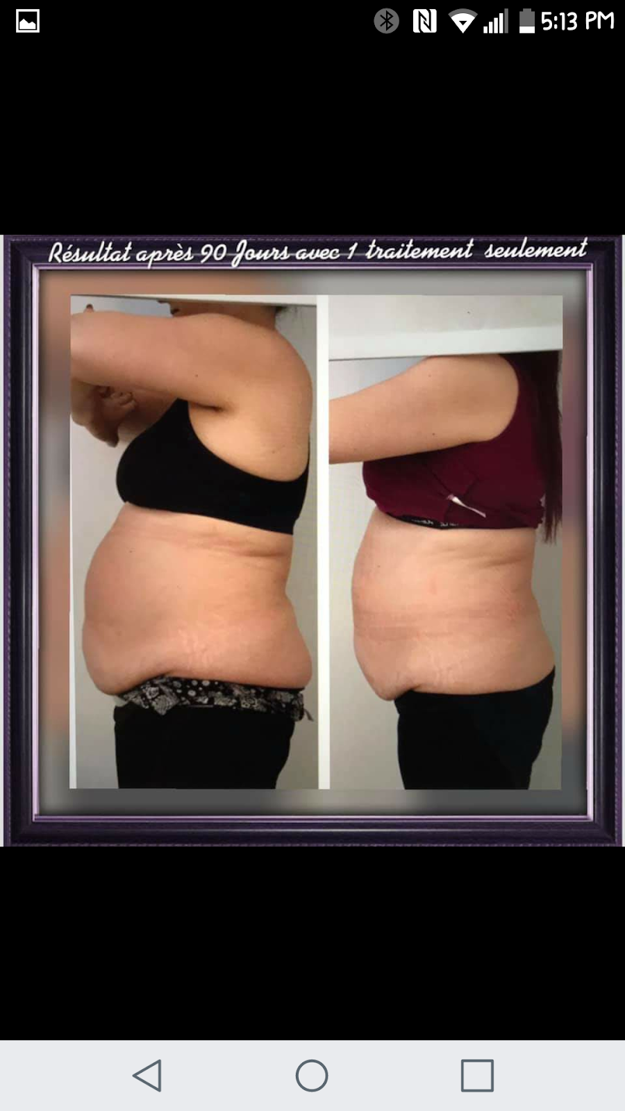 New You Body Sculpting | 921 Notre Dame St, Embrun, ON K0A 1W0, Canada | Phone: (613) 880-3400