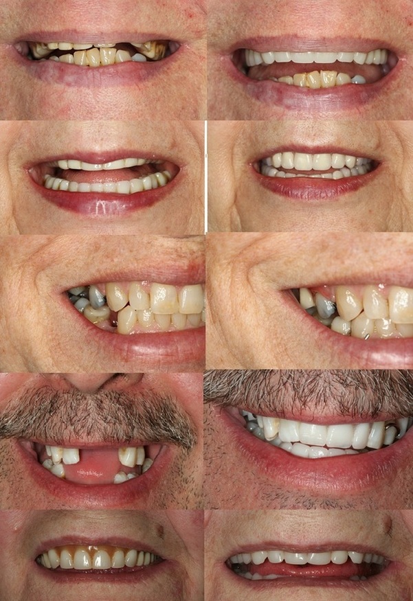 Sergey Haletski, DD | Mobile at-home Denture Clinic | 190 Sherway Dr, Etobicoke, ON M9C 5N2, Canada | Phone: (416) 939-0292