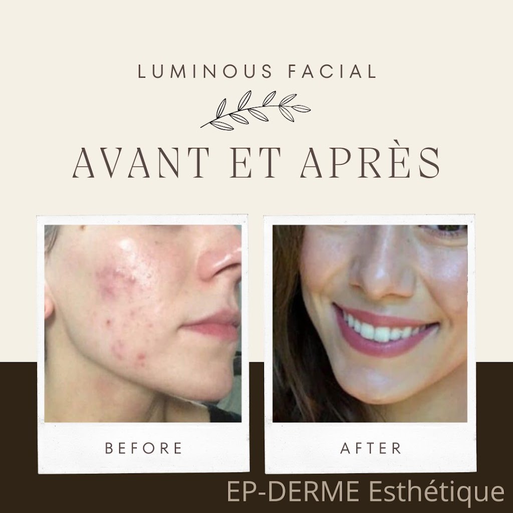 EP-DERME Esthétique - Microdermabrasion - Mont-Laurier | 2322 Chemin du Rang 4 S, Mont-Laurier, QC J9L 3G3, Canada | Phone: (819) 616-7888