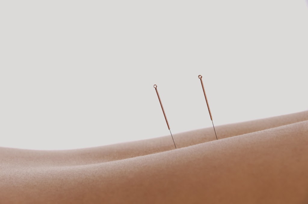 Acupuncture in Calgary | 2580 Southland Dr SW #50, Calgary, AB T2V 4J8, Canada | Phone: (403) 281-2333