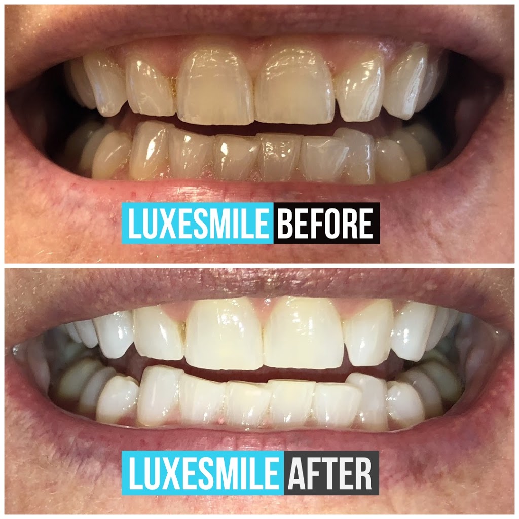 LuxeSmile | Teeth Whitening is all we do! | 22 Mill St S Unit 102, Waterdown, ON L0R 2H0, Canada | Phone: (905) 469-6093