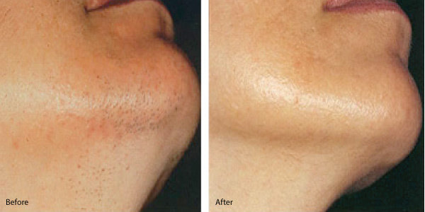 FolliCare Electrolysis Hair Removal | 1829 Ranchlands Blvd NW #231, Calgary, AB T3G 2A7, Canada | Phone: (403) 617-5857