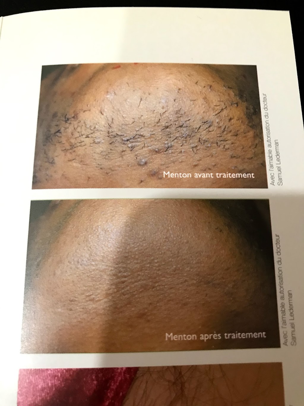 Aesthetic Laser Hair Removal Manon Tremblay | 13604 Bd du Curé-Labelle, Mirabel, QC J7J 1H1, Canada | Phone: (450) 675-3133