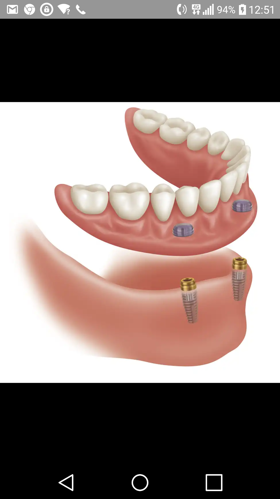 Denturologiste Saint Laurent | Prothèses dentaires Mon Sourire | 2505 Rue des Nations, Saint-Laurent, QC H4R 3C8, Canada | Phone: (514) 333-3368