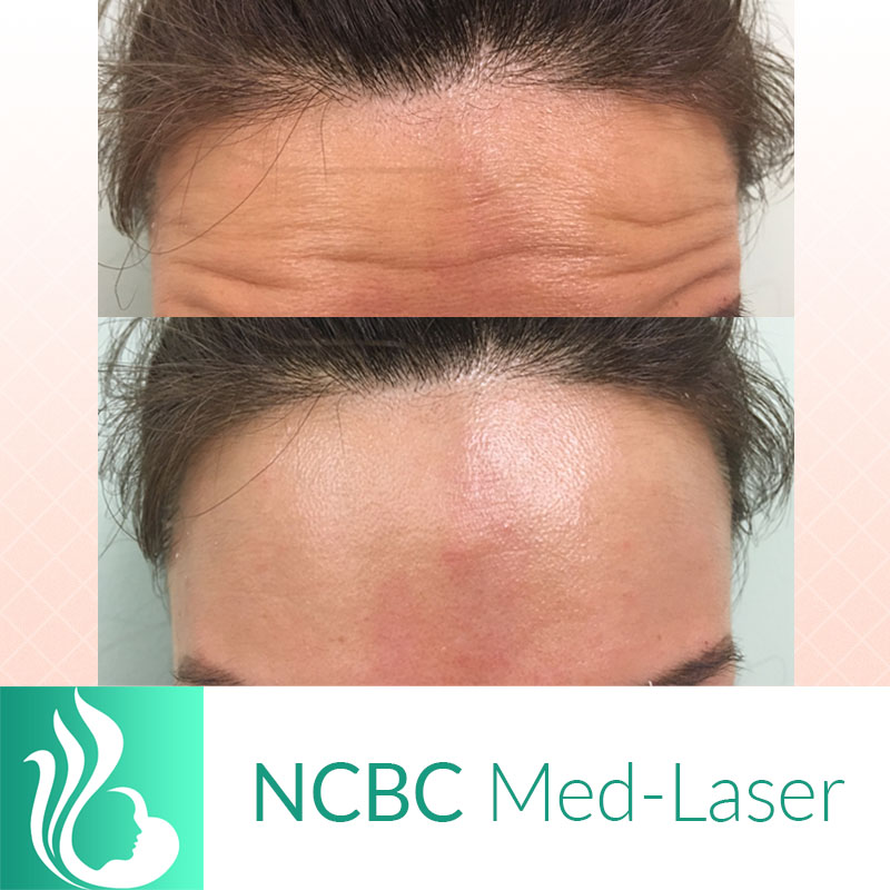 NCBC Med-Laser | 2090 Lawrence Ave E, Scarborough, ON M1R 2Z5, Canada | Phone: (416) 931-4772