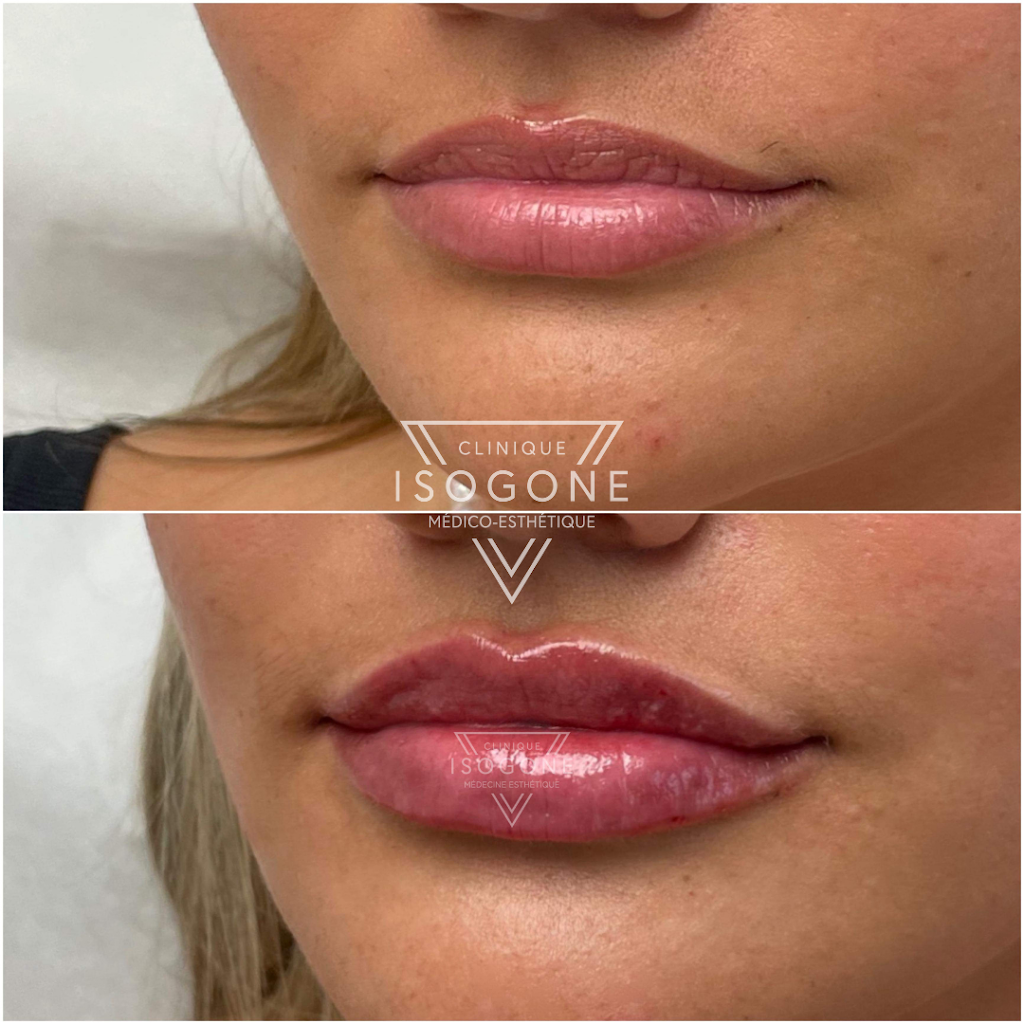 Clinique Isogone Médico-Esthétique | 1435 Boulevard Saint-Martin O Suite 502, Laval, QC H7S 2C6, Canada | Phone: (450) 667-6676