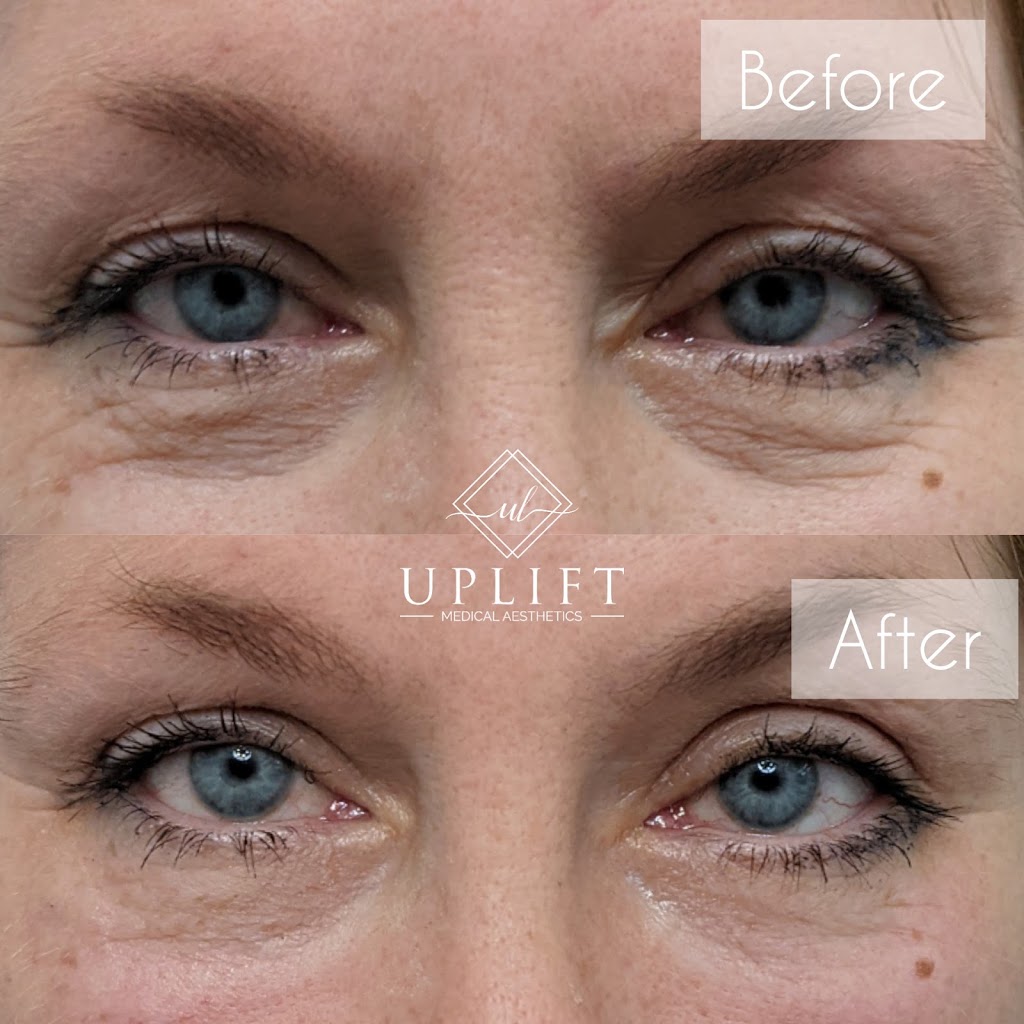 Uplift Medical Aesthetics | 2022 Main St N, Jarvis, ON N0A 1J0, Canada | Phone: (519) 420-9225