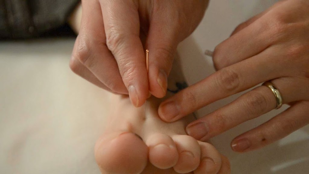 ACUPUNCTURE BY AMY, Amy Wan R. Ac. | 5677 99 St NW #101, Edmonton, AB T6E 3N8, Canada | Phone: (780) 439-4321