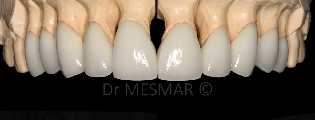 Le Prosthodontiste - Dr Samer Mesmar | 5255 Boul Henri-Bourassa O #402, Saint-Laurent, QC H4R 2M6, Canada | Phone: (514) 587-6696