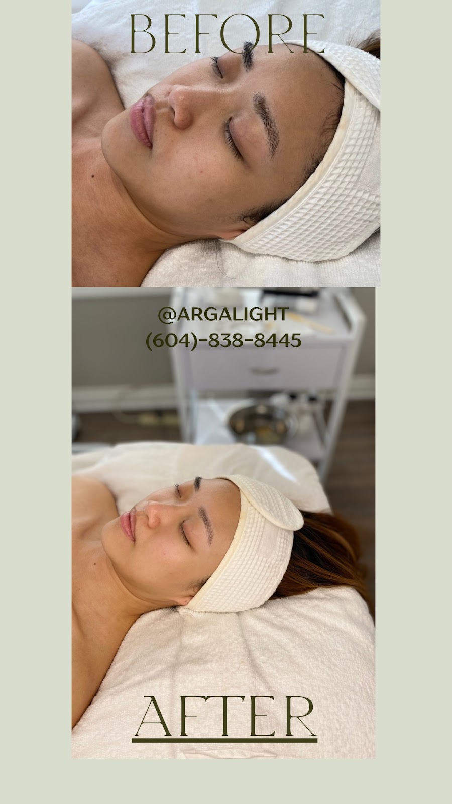 Arga Light Laser& Skin Care | 3059 Timber Ct, Coquitlam, BC V3E 2Y8, Canada | Phone: (604) 838-8445