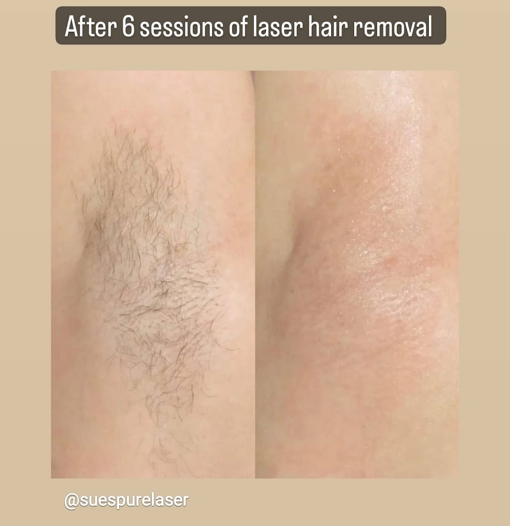 SUES PURE LASER | 75 Templebow Way NE, Calgary, AB T1Y 5B5, Canada | Phone: (587) 439-2776