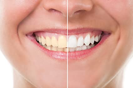 White Smiles | 9832 204 St, Langley City, BC V1M 0A6, Canada | Phone: (604) 879-9099