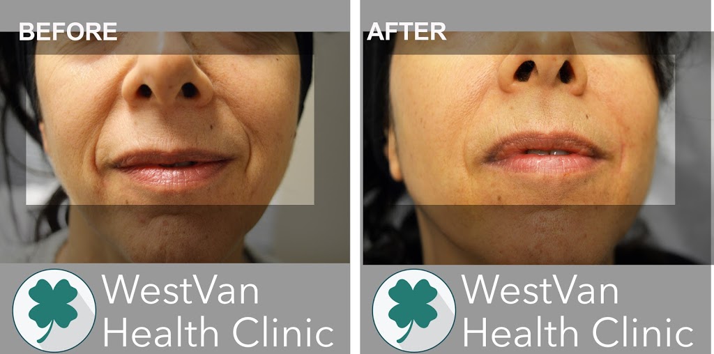 WestVan Health Clinic | 2419 Bellevue Ave #119, West Vancouver, BC V7V 4T4, Canada | Phone: (604) 922-8800