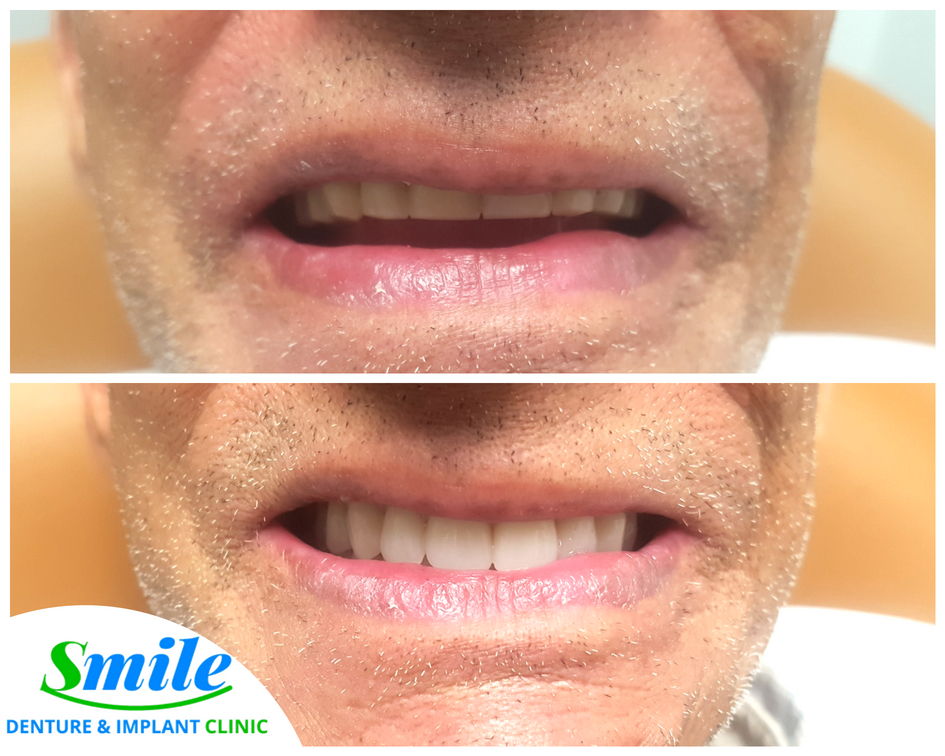 Smile Denture & Implant Clinic | 1825 Woodward Dr, Ottawa, ON K2C 0P9, Canada | Phone: (613) 702-2656