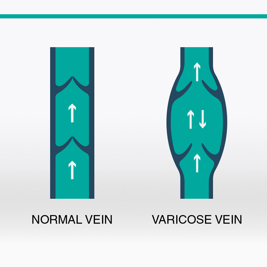 Varicose Vein Clinic of BC | 168 13th St E #202, North Vancouver, BC V7L 4W8, Canada | Phone: (604) 986-4772