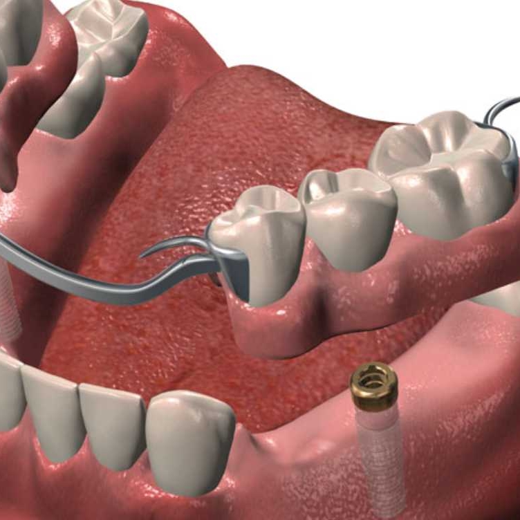 Denturologie Mon Sourire I Denturologiste Saint Laurent | 2505 Rue des Nations, Saint-Laurent, QC H4R 3C8, Canada | Phone: (514) 506-4983