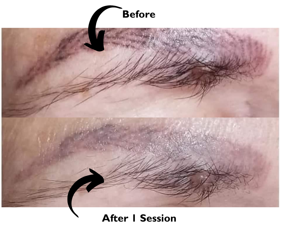 Emergency Removal - Eyebrow Tattoo Removal | 11675 Seventh Ave, Richmond, BC V7E 4X4, Canada | Phone: (672) 514-1790