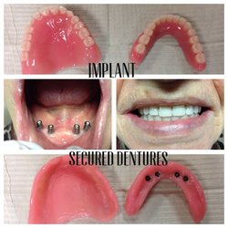 Implant Dentures | 18 Church St, Georgetown, ON L7G 2A5, Canada | Phone: (905) 877-2359