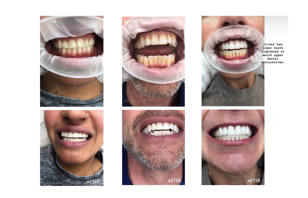 Adorn Teeth Whitening | 4520 Viscount Dr NW, Calgary, AB T3A 0N9, Canada | Phone: (403) 829-6783