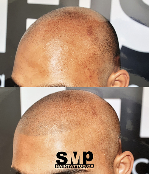 SMP® Scalp Micropigmentation Richmond Hill | HAIRTATTOO.CA | 9140 Leslie St #301, Richmond Hill, ON L4B 3L6, Canada | Phone: (647) 492-9093