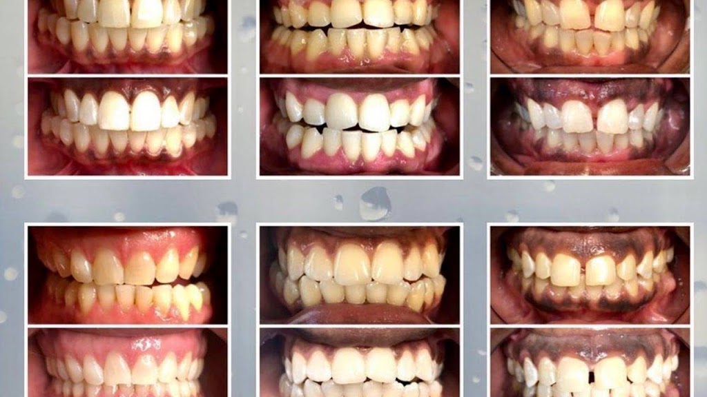 Luminescent Smile | 10 Brian Ave, Scarborough, ON M1R 3H9, Canada | Phone: (416) 804-4133