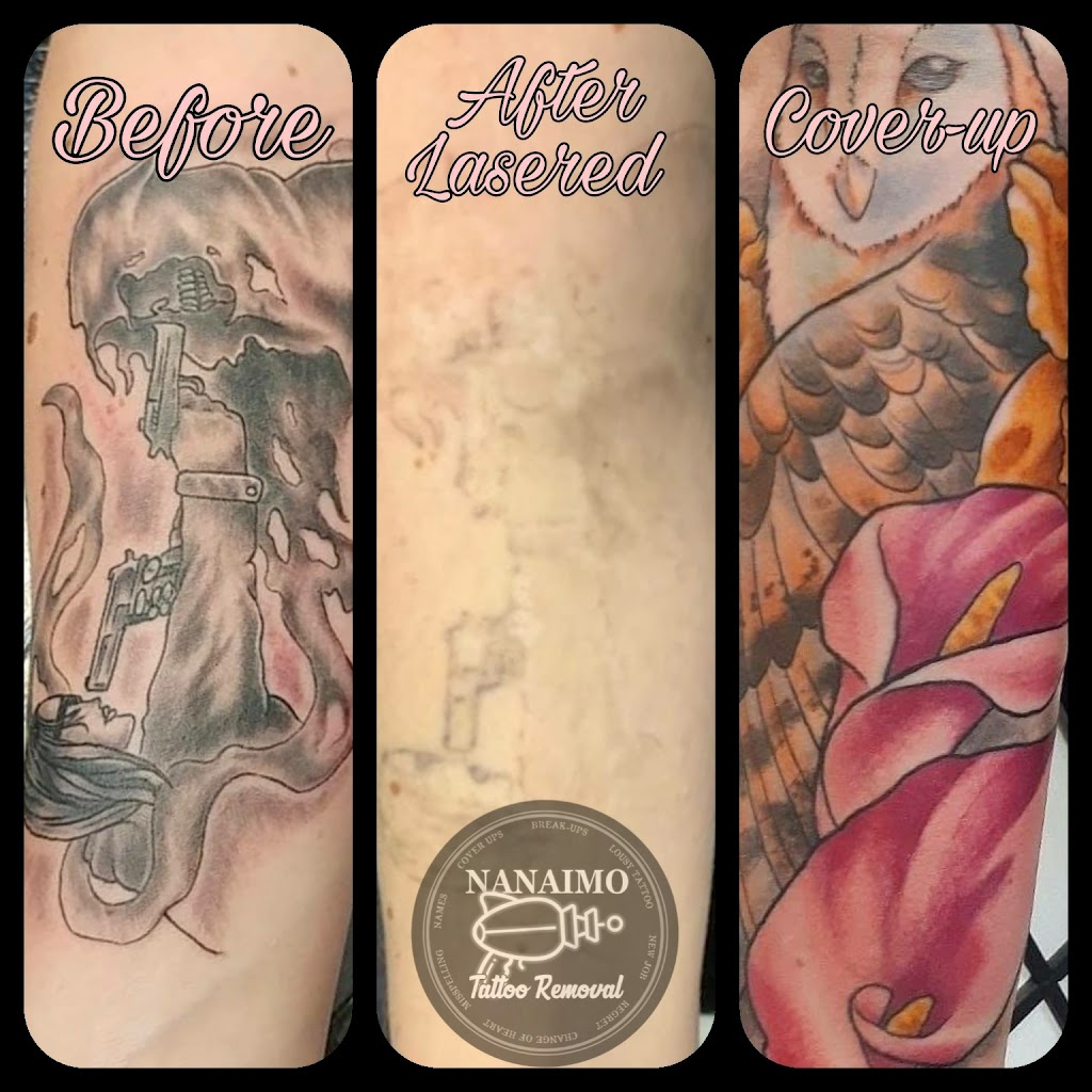 Nanaimo Tattoo Removal | 1925 Bowen Rd Unit #200, Nanaimo, BC V9S 1H1, Canada | Phone: (250) 327-7579