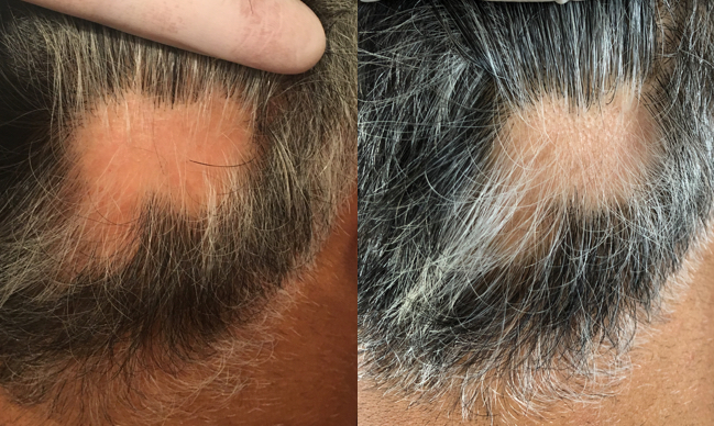 TRICHOLOGY CENTRE | Hair Loss and SMP Scalp Micropigmentation Ri | 9140 Leslie St Unit 301, Richmond Hill, ON L4B 3L6, Canada | Phone: (647) 492-9093