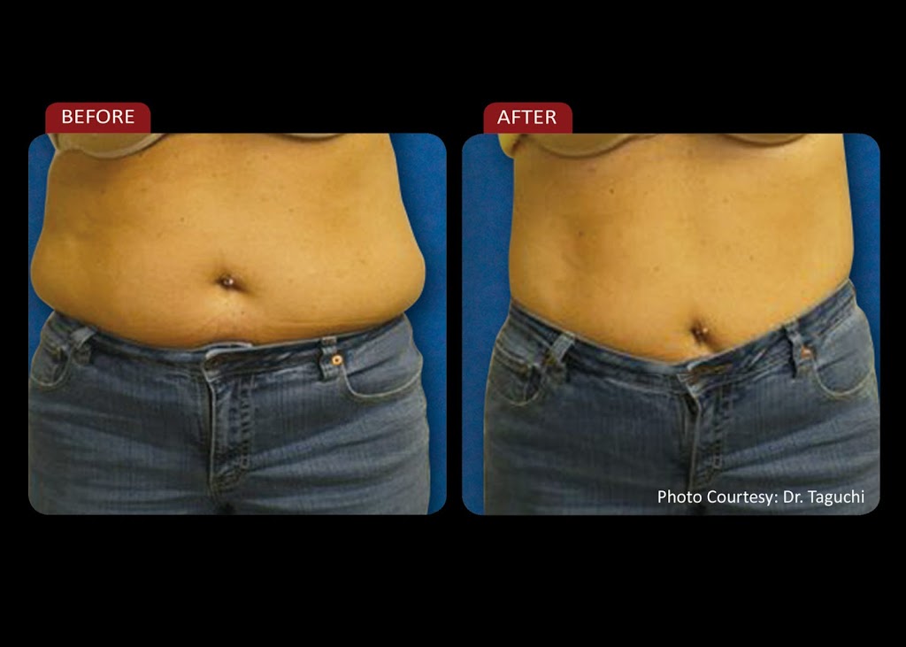 Global Laser Body Contouring | 208-269 Boul Saint-Jean, Pointe-Claire, QC H9R 3J1, Canada | Phone: (514) 619-2575