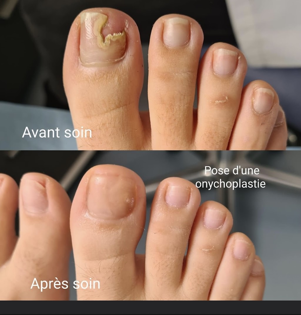 Clinique de soins de pieds/soins infirmiers Beauport | 202 Avenue St Michel, Québec, QC G1C 1G1, Canada | Phone: (418) 265-9447