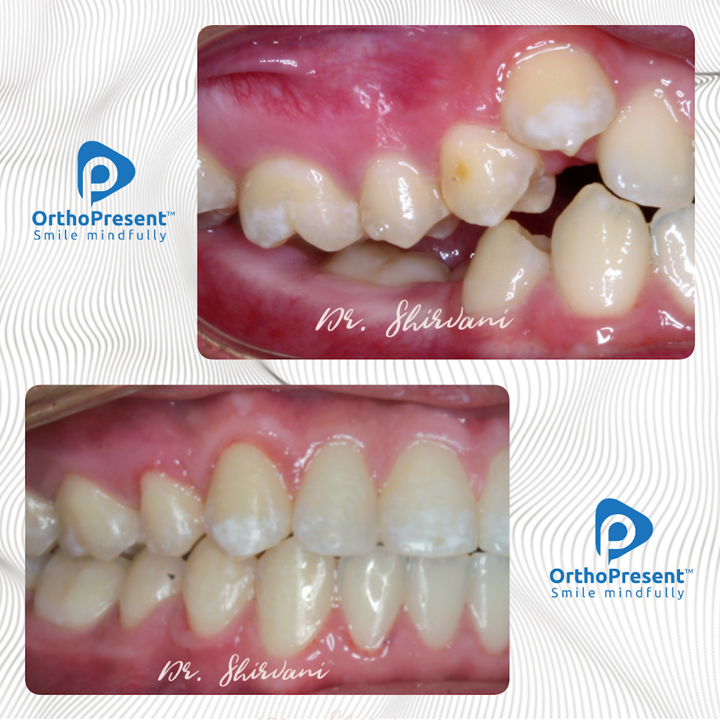 Phoenix Dental Implant and Invisalign Centre | 770 Kingsway, Vancouver, BC V5V 3C1, Canada | Phone: (604) 256-9619