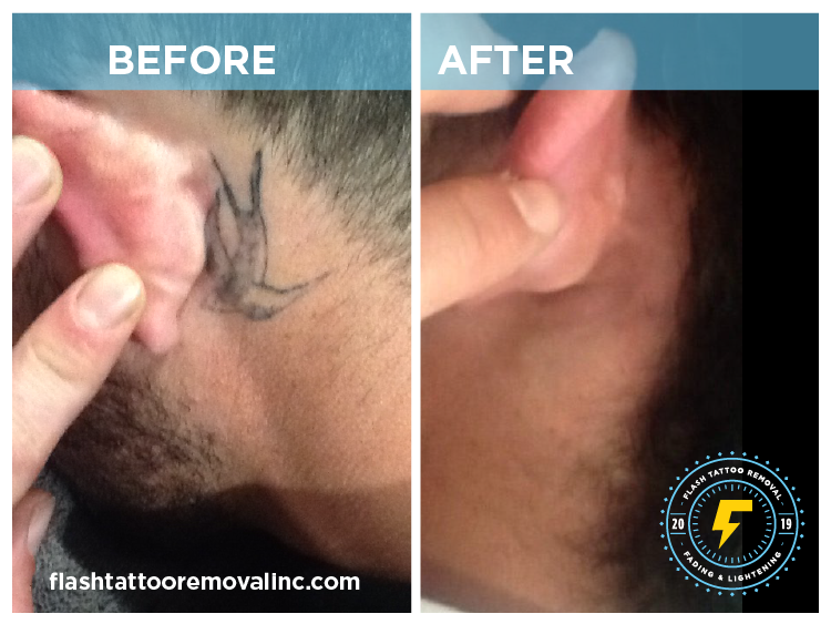 FLASH Tattoo Removal Calgary | 1530 9 Ave SE, Calgary, AB T2G 0T7, Canada | Phone: (403) 978-5488