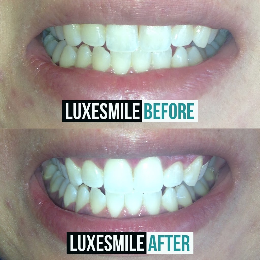 LuxeSmile | Teeth Whitening is all we do! | 22 Mill St S Unit 102, Waterdown, ON L0R 2H0, Canada | Phone: (905) 469-6093