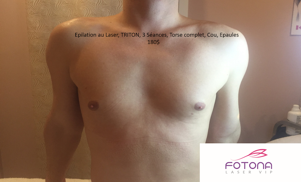 FOTONA Laser VIP | 4021 Boulevard Saint-Martin O #101, Laval, QC H7T 1B7, Canada | Phone: (514) 834-9298