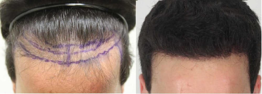 Rahal Hair Transplant Toronto | 1131 Leslie St #300, North York, ON M3C 3L8, Canada | Phone: (647) 559-2811